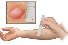 PPD testi
